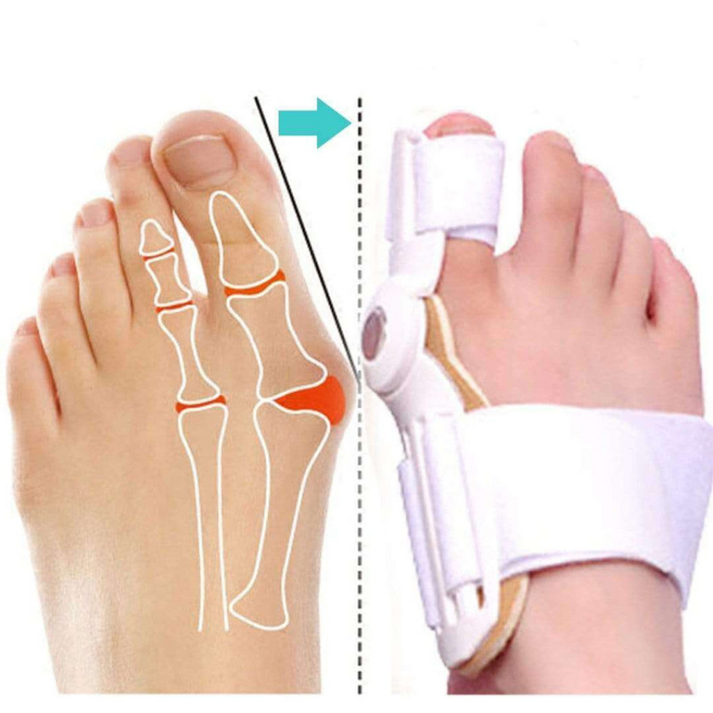 AlignaStep™ — Mettez fin à la douleur des oignons et avancez en toute confiance vers le confort