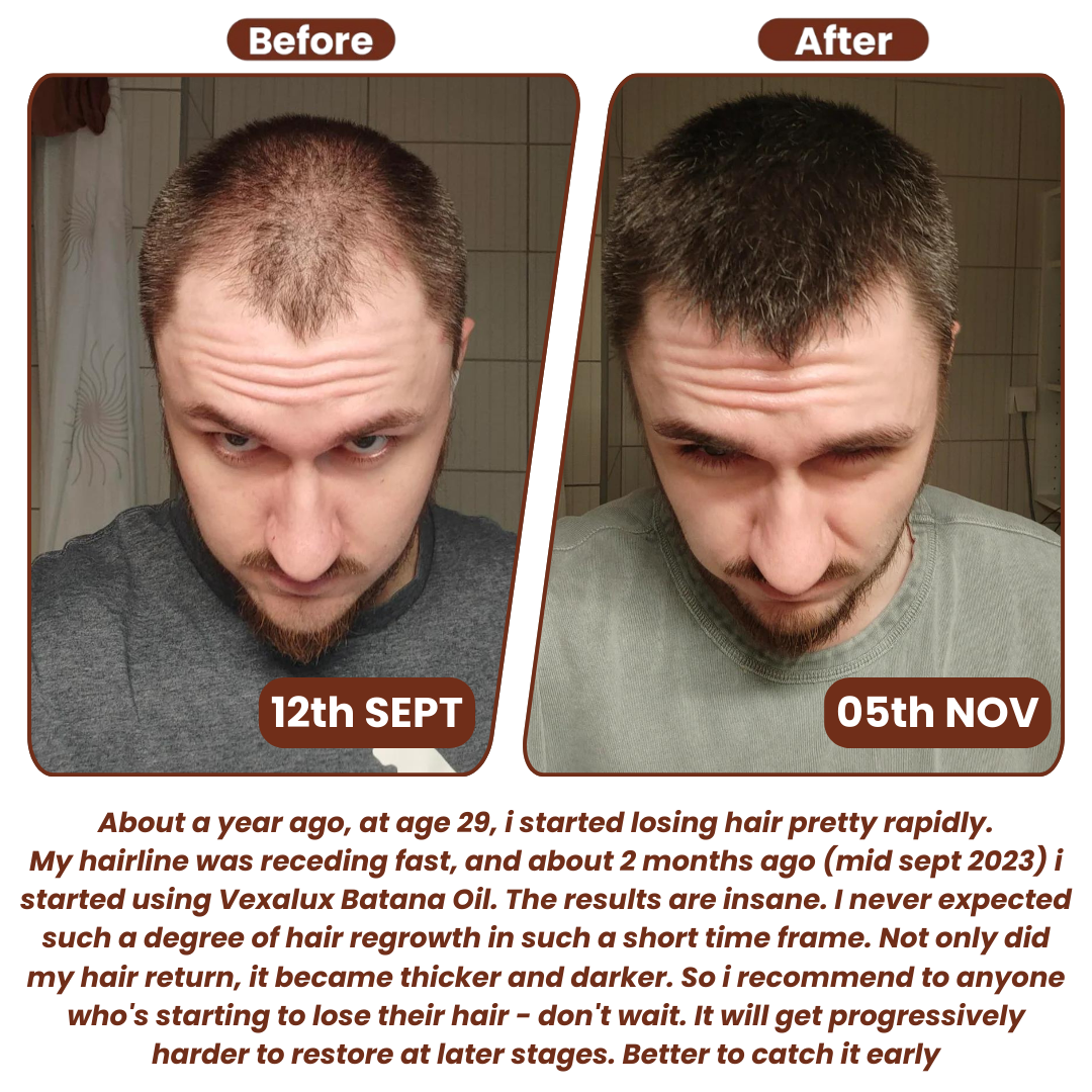 (1+1 GRATUIT) Caremey™ — Transformez les Cheveux Fins en une Couronne Épaisse et Audacieuse en Seulement 14 Jours