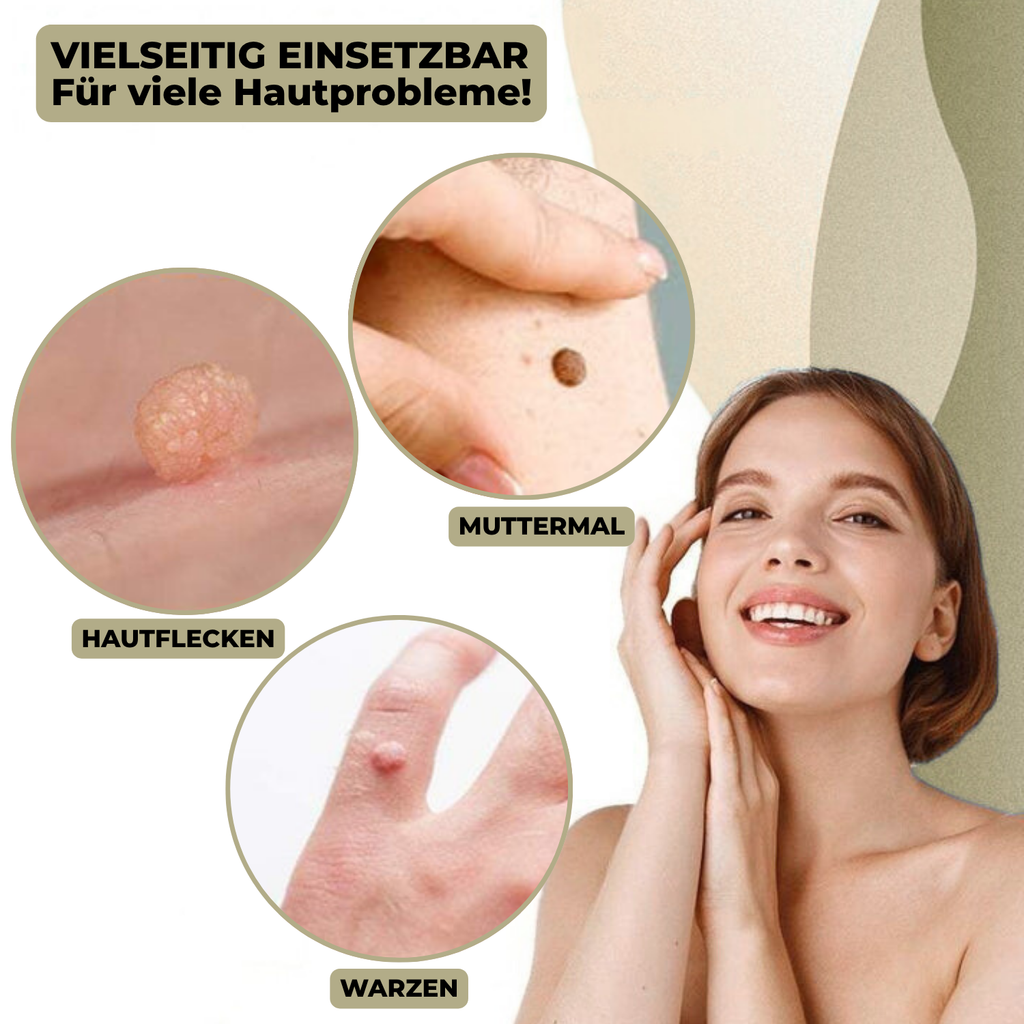 DermaLinx Éliminateur de Verrues | Élimination sans douleur des verrues et des grains de beauté | Pour la maison | Sans opération