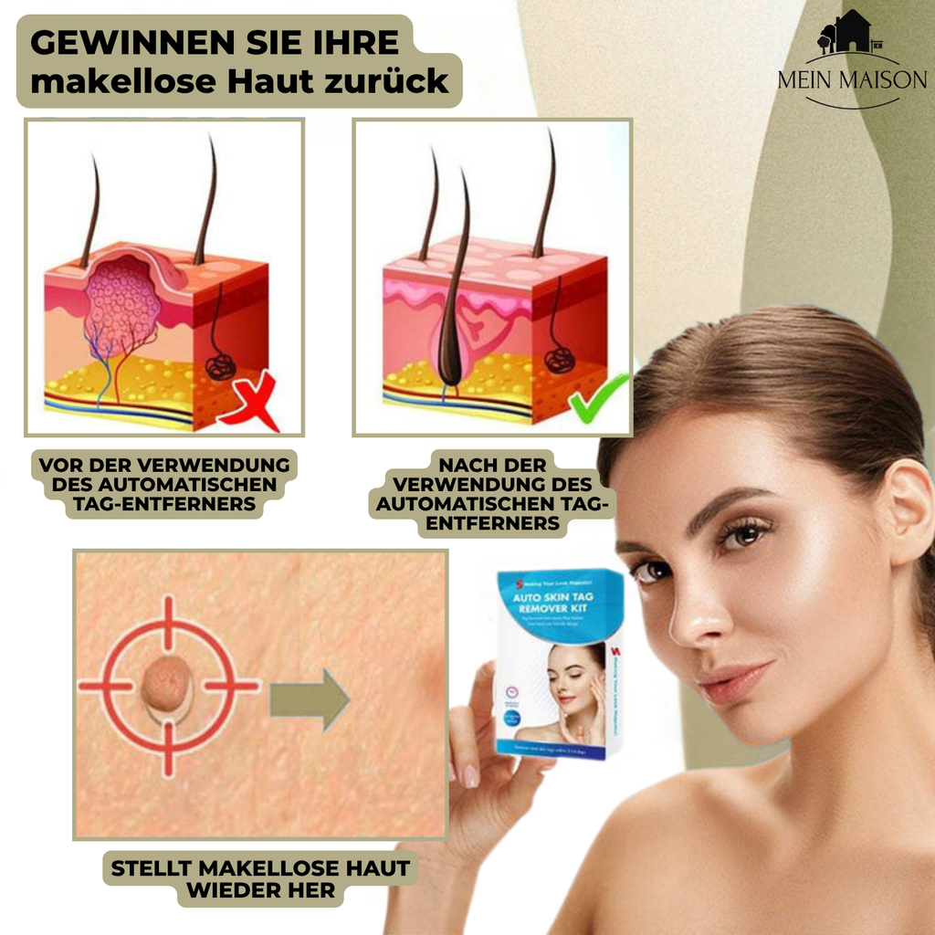 DermaLinx Éliminateur de Verrues | Élimination sans douleur des verrues et des grains de beauté | Pour la maison | Sans opération