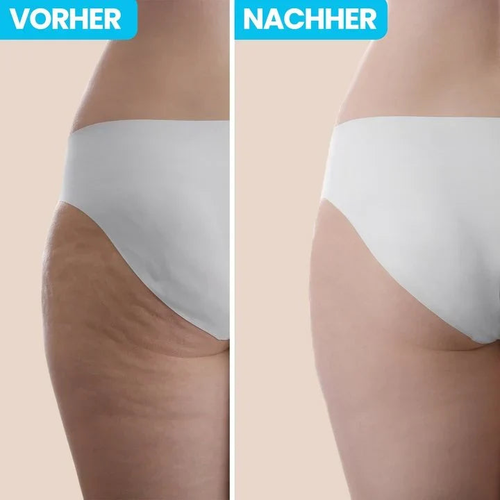 60 % de réduction | CelluPro™️ Éliminez la cellulite confortablement depuis chez vous !