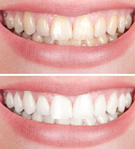 DazzlePro™ — Éveillez Instantanément l'Éclat Naturel et la Confiance de Votre Sourire