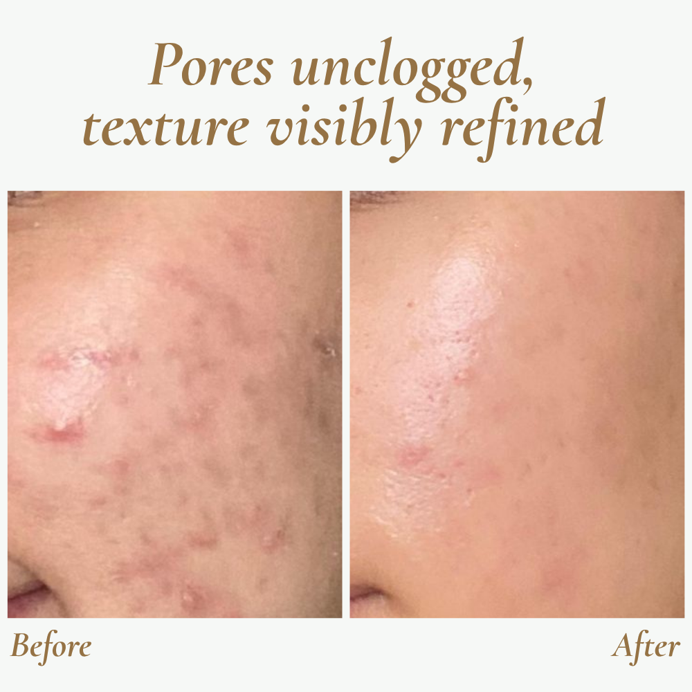 SkinPulse™ - Nettoyage Ultrasonique Professionnel de la Peau
