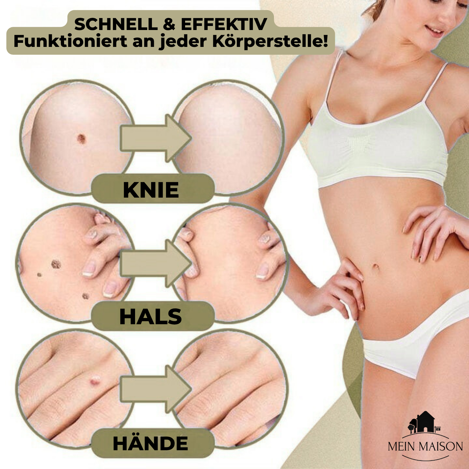DermaLinx Éliminateur de Verrues | Élimination sans douleur des verrues et des grains de beauté | Pour la maison | Sans opération