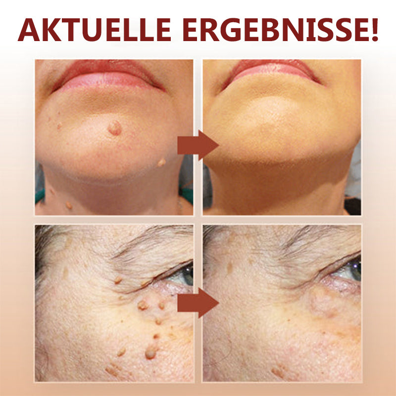 1 + 1 GRATUIT | Essence pour l'élimination des taches et des grains de beauté