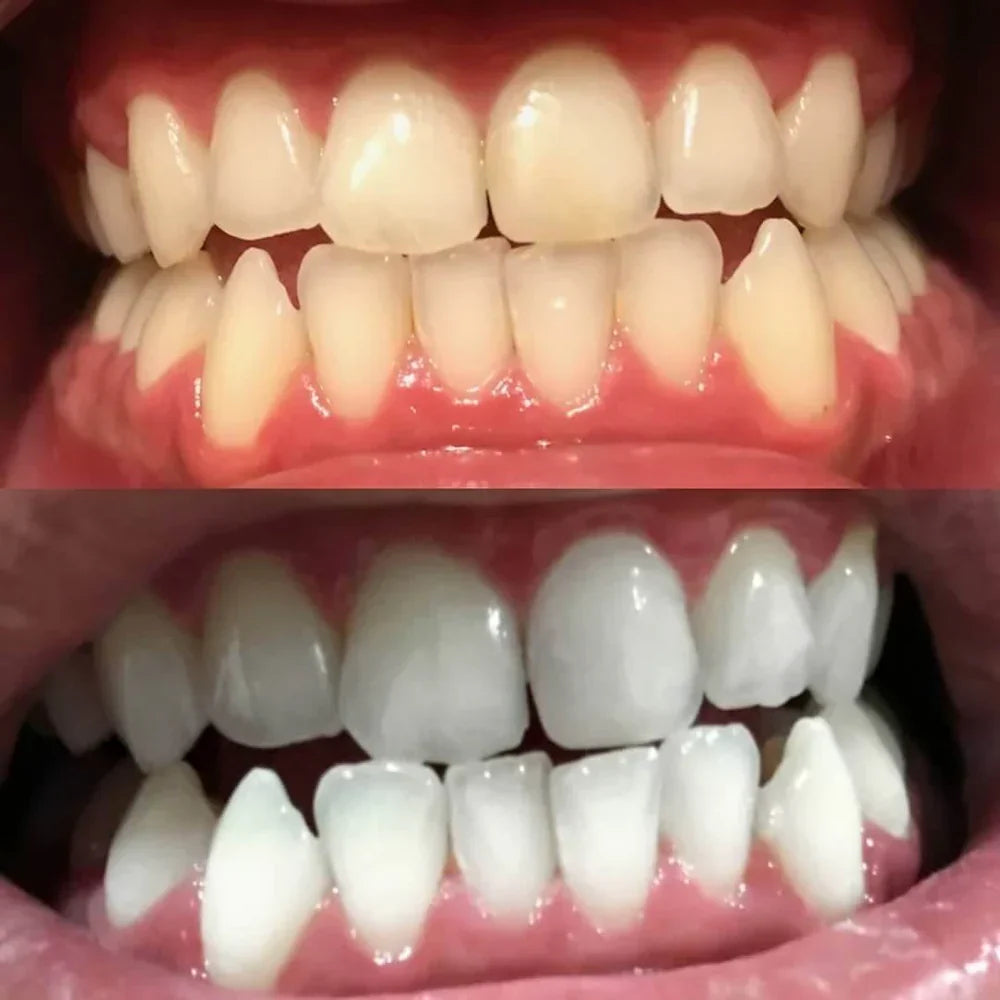 ShinySmile™ — Blanchissez Instantanément & Renforcez Votre Confiance | 1+1 GRATUIT