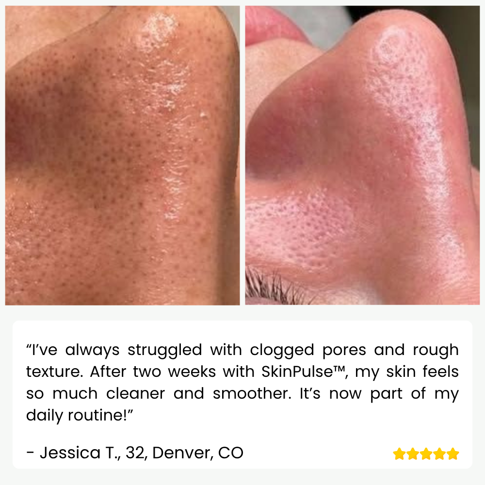 SkinPulse™ - Nettoyage Ultrasonique Professionnel de la Peau