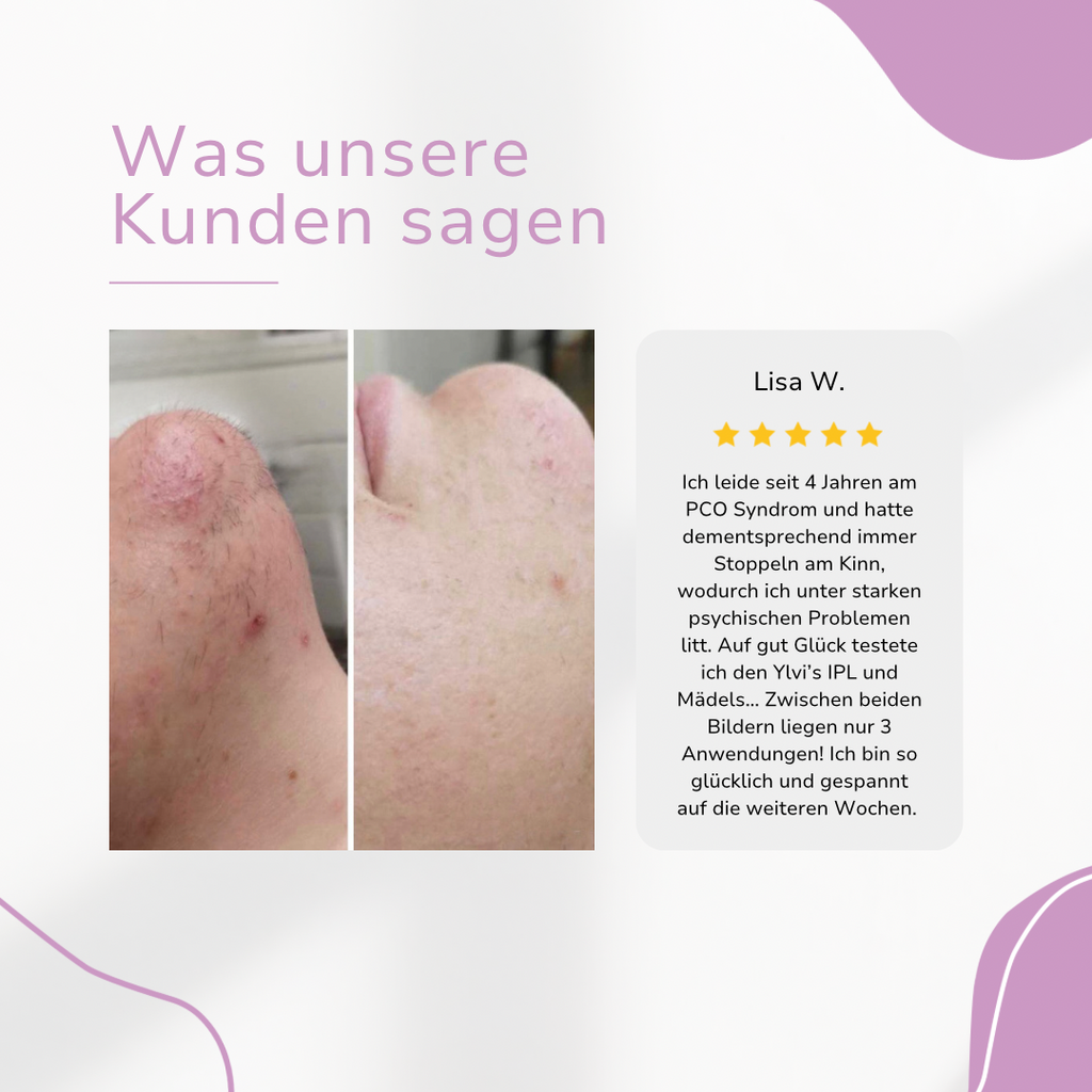 Venzani Ylvis IPL Épilateur I La meilleure épilation au laser à domicile