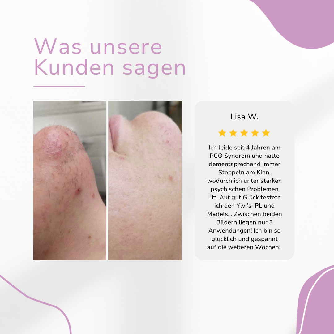 Venzani Ylvis IPL Épilateur I La meilleure épilation au laser à domicile