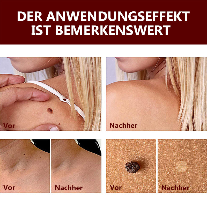 1 + 1 GRATUIT | Essence pour l'élimination des taches et des grains de beauté