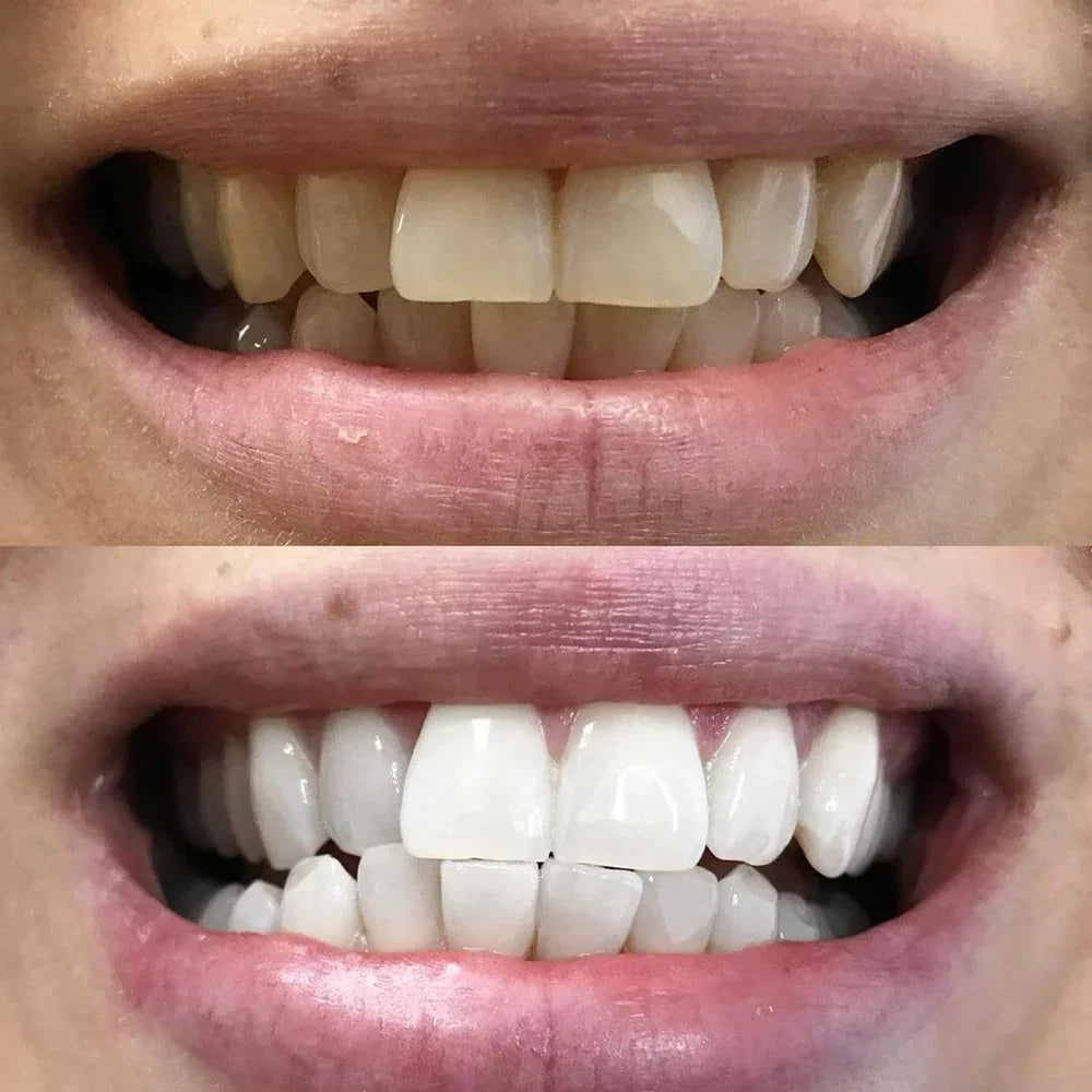 ShinySmile™ — Blanchissez Instantanément & Renforcez Votre Confiance | 1+1 GRATUIT