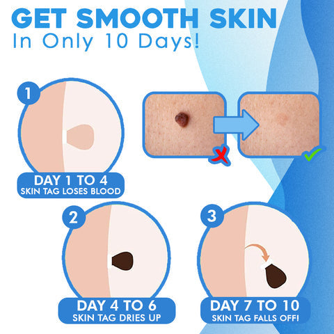 ClearSkinX™ — Éliminez les Verrues Rapidement et Libérez Votre Peau Radieuse et Éblouissante (KIT COMPLET)