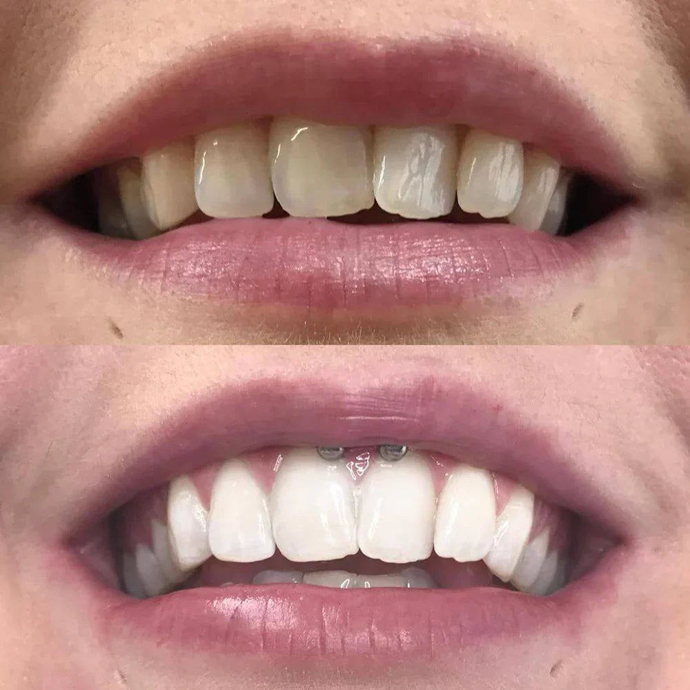 ShinySmile™ — Blanchissez Instantanément & Renforcez Votre Confiance | 1+1 GRATUIT