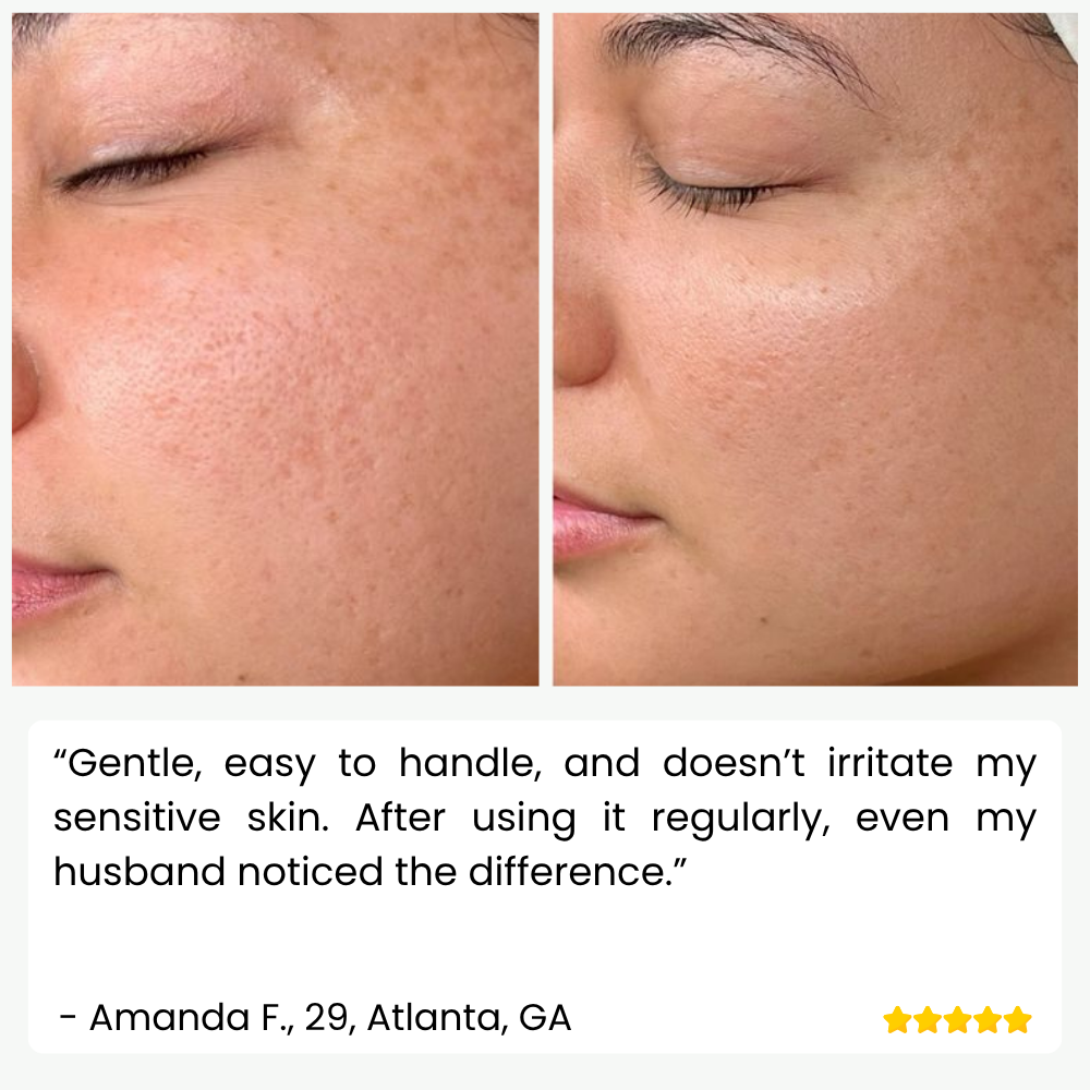 SkinPulse™ - Nettoyage Ultrasonique Professionnel de la Peau