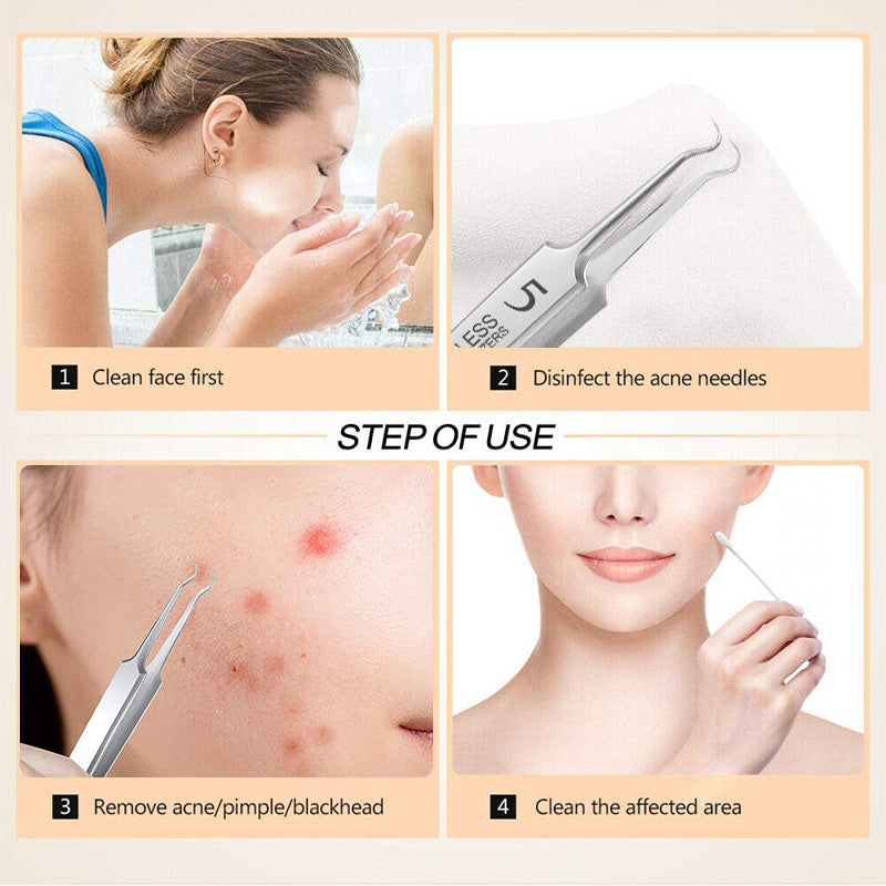 DermaSculpt™ Ensemble de Pinces — Déverrouillez une Peau Parfaite et Confiance avec une Extraction Précise et Sans Douleur