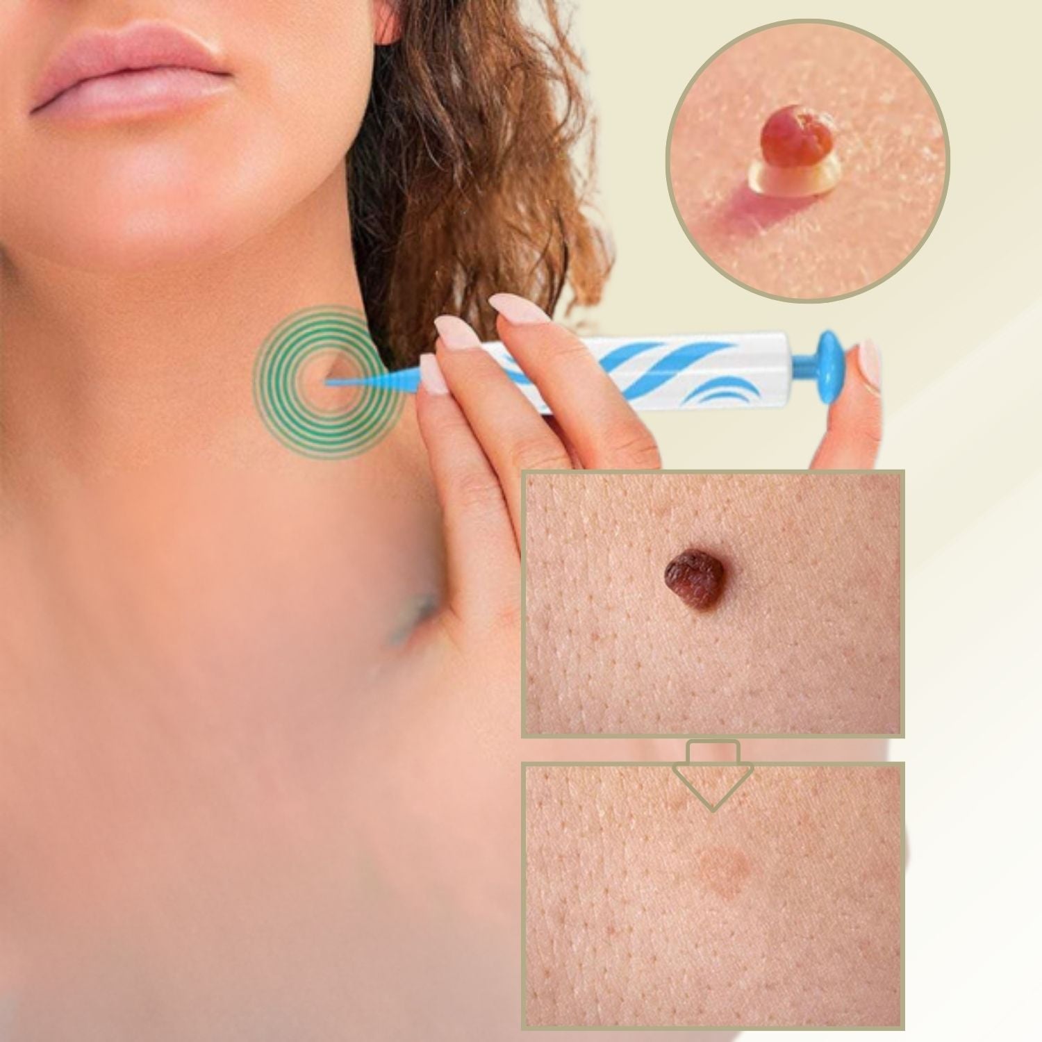 DermaLinx Éliminateur de Verrues | Élimination sans douleur des verrues et des grains de beauté | Pour la maison | Sans opération