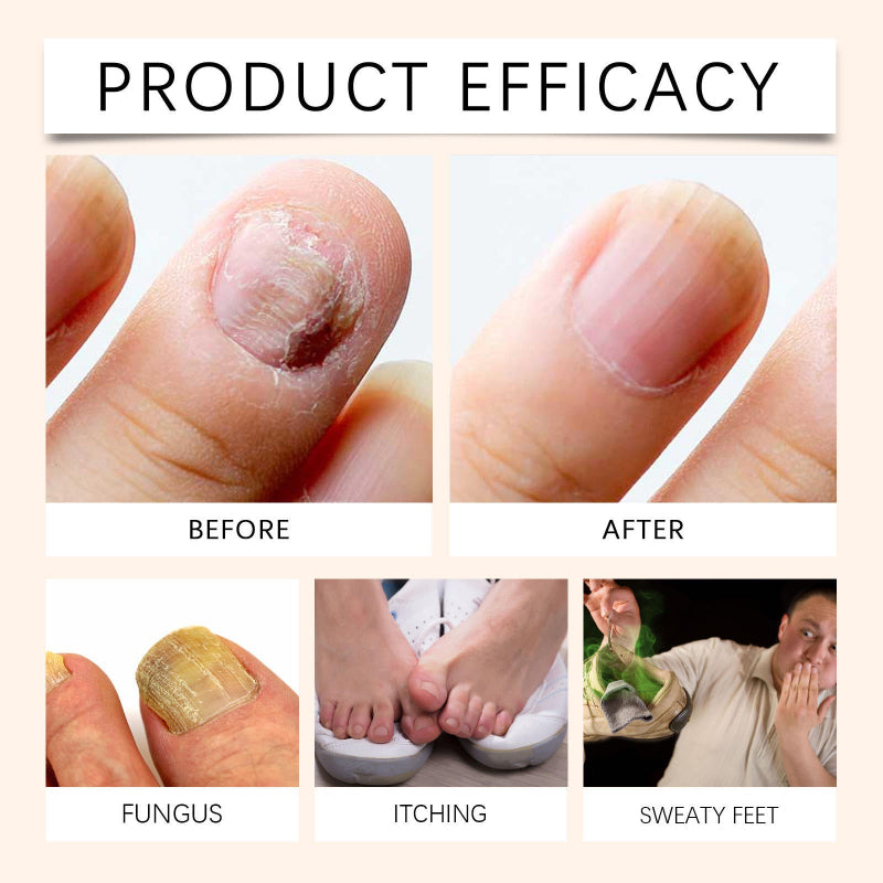 NailSpray 1+1 GRATUIT - Facile à Utiliser Spray Réparateur Apaisant pour les Ongles