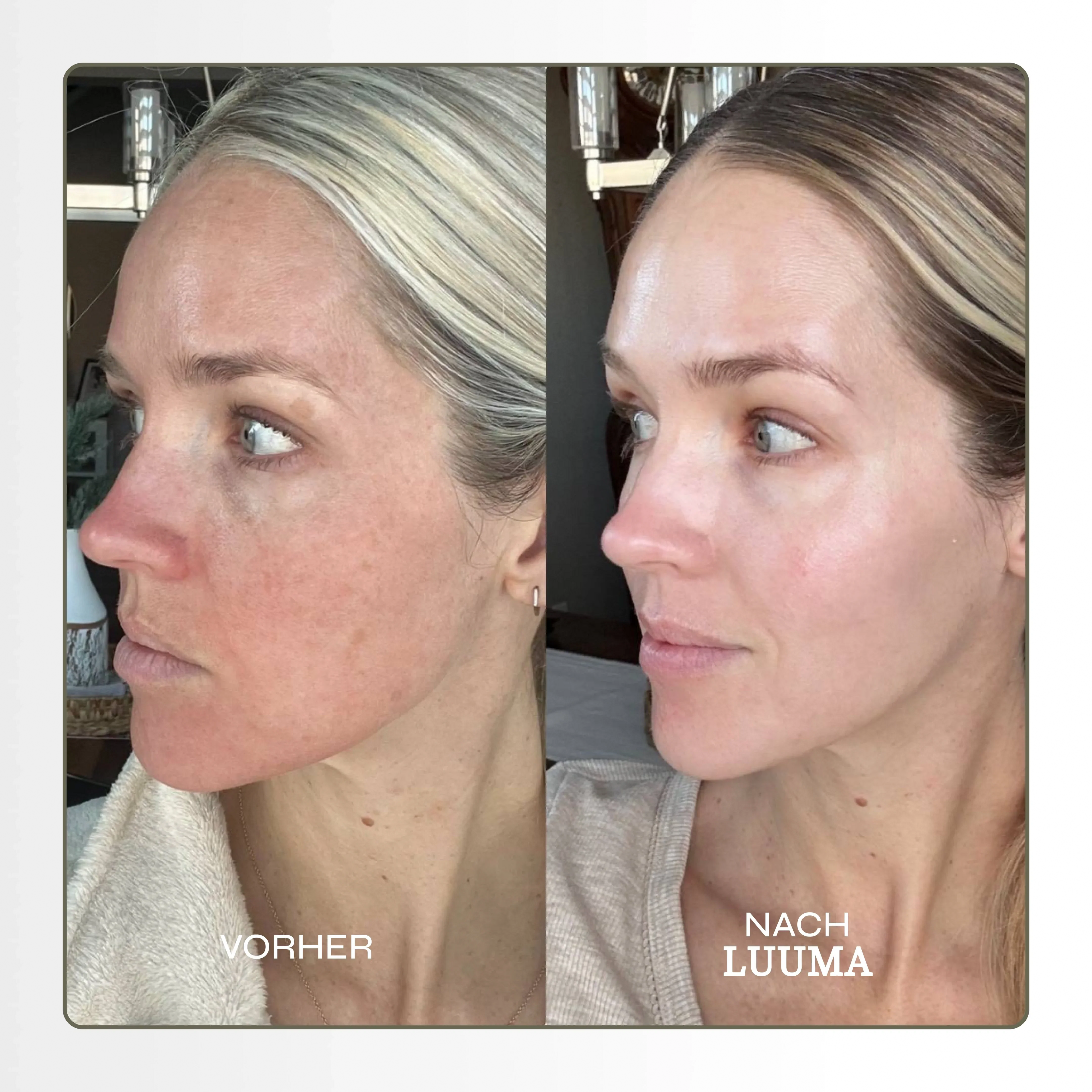 Luma™ | Kit d'infusions Mikro