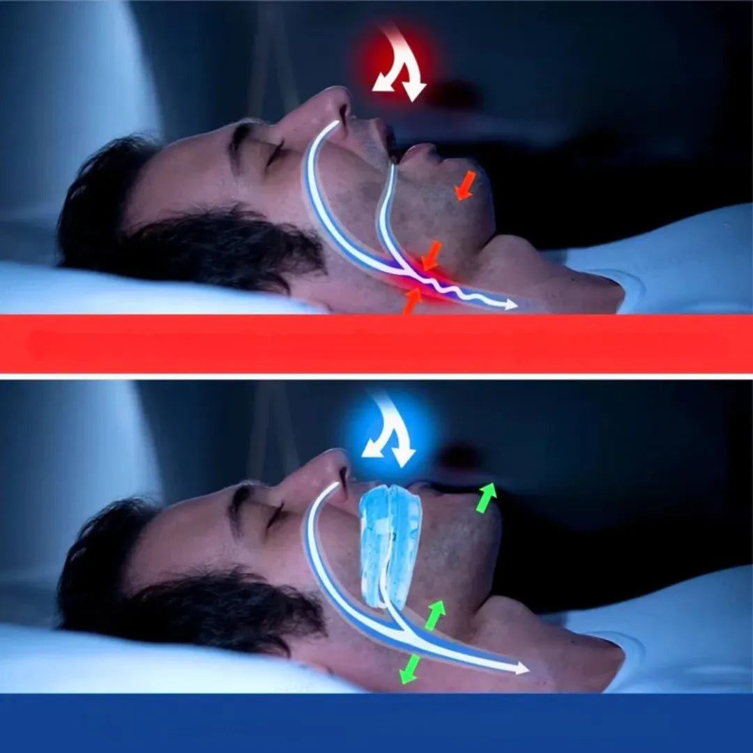 SleepEase - Anti Ronflement pour un Meilleur Sommeil - Embout Réglable pour des Nuits Calmes