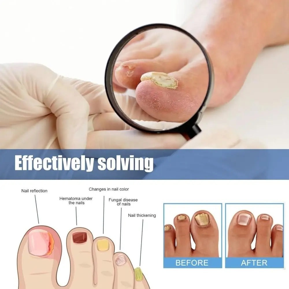 FungalPatch - Patch Antibactérien et Antifongique Pour Les Ongles