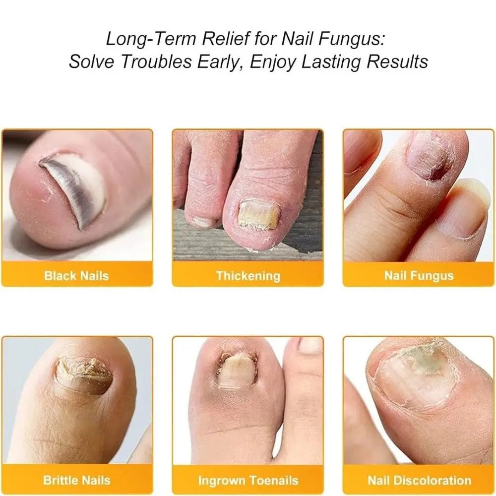 FungalPatch - Patch Antibactérien et Antifongique Pour Les Ongles
