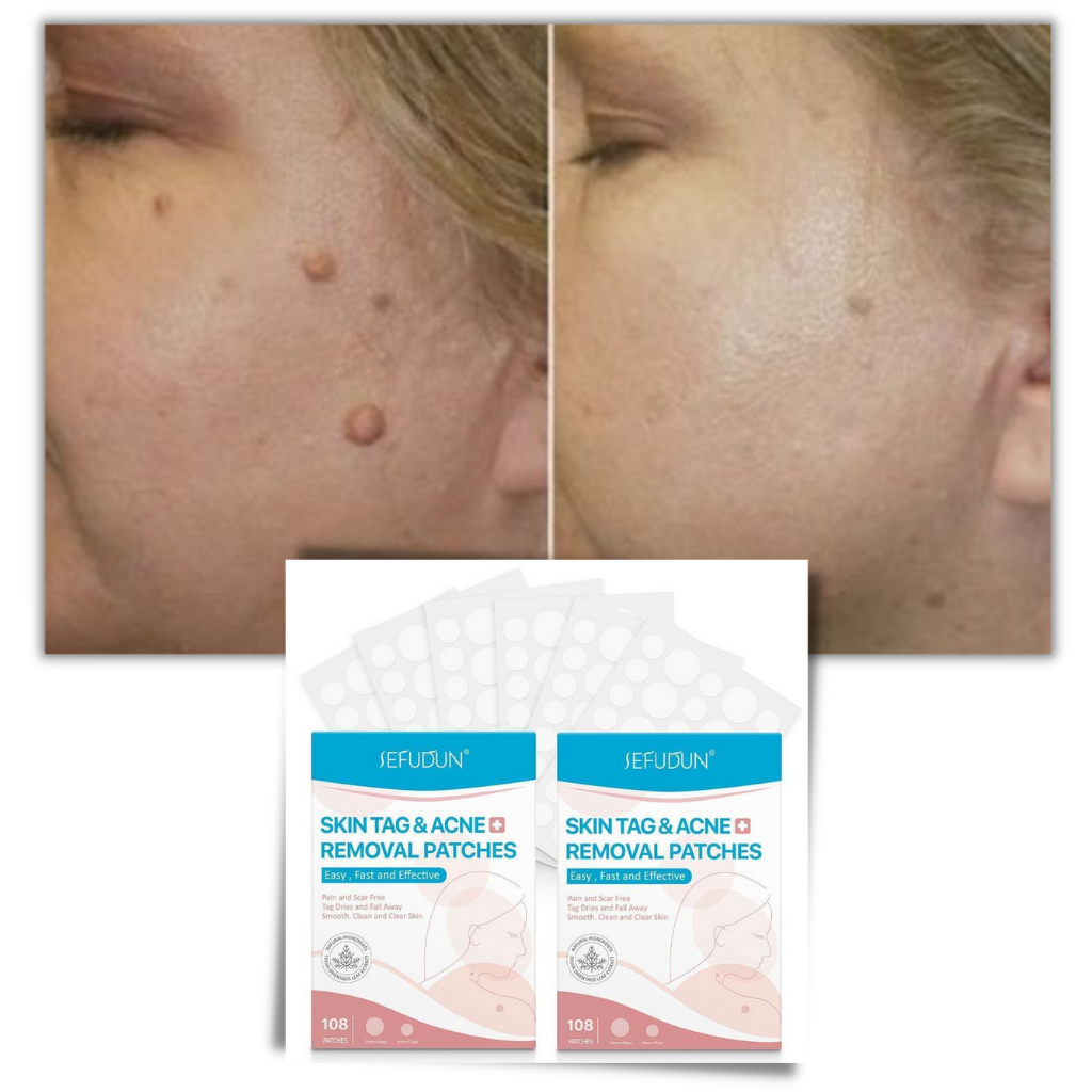 Skanto | Patch cutané - Éliminez les grains de beauté et les verrues de manière naturelle !