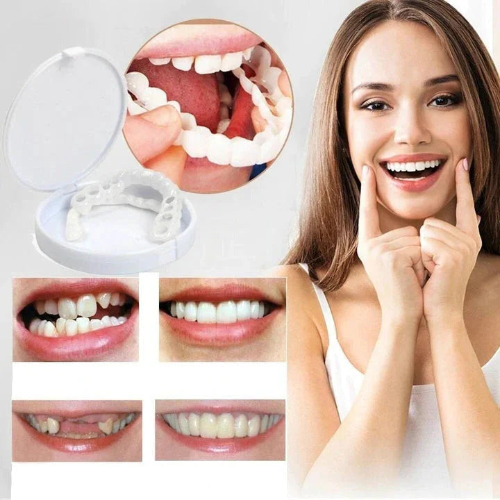 Ensemble de Facettes Amovibles pour Dents Supérieures et Inférieures avec Ajustement Personnalisé | Solution Amovible pour un Sourire Naturel