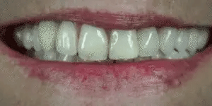 Ensemble de Facettes Amovibles pour Dents Supérieures et Inférieures avec Ajustement Personnalisé | Solution Amovible pour un Sourire Naturel