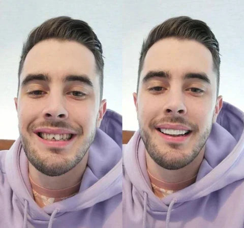 Ensemble de Facettes Amovibles pour Dents Supérieures et Inférieures avec Ajustement Personnalisé | Solution Amovible pour un Sourire Naturel