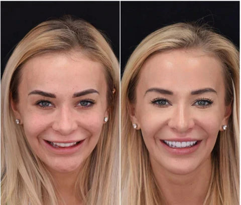 Ensemble de Facettes Amovibles pour Dents Supérieures et Inférieures avec Ajustement Personnalisé | Solution Amovible pour un Sourire Naturel