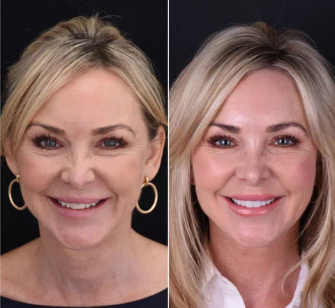 Ensemble de Facettes Amovibles pour Dents Supérieures et Inférieures avec Ajustement Personnalisé | Solution Amovible pour un Sourire Naturel
