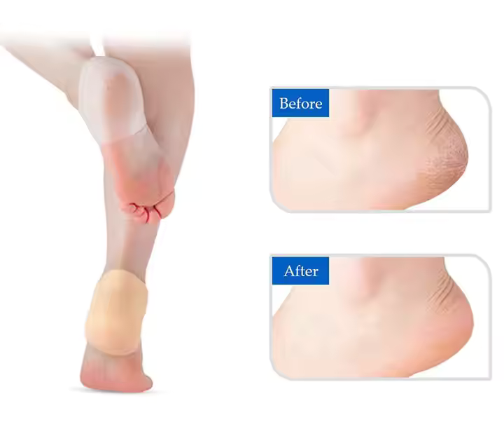 Happy™ HeelProtector 1+1 GRATUIT - Protecteur de Talon en Silicone Doux
