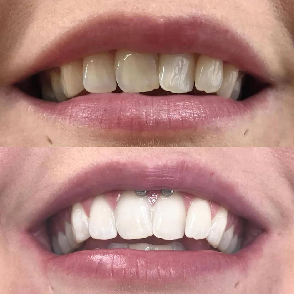 RadianceRush™ — Illuminez Chaque Pièce avec un Sourire Qui Rayonne de Confiance
