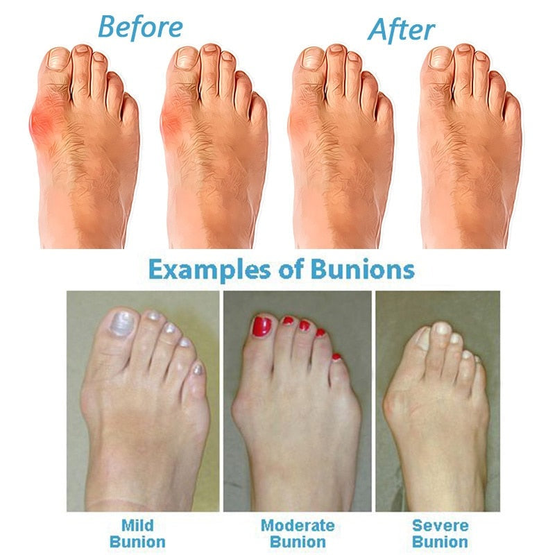 Sandales pour Hallux Valgus - Édition OrthoSole Été 2025