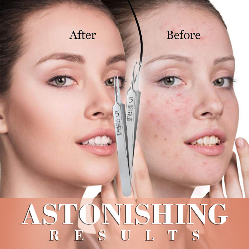 DermaSculpt™ Ensemble de Pinces — Déverrouillez une Peau Parfaite et Confiance avec une Extraction Précise et Sans Douleur