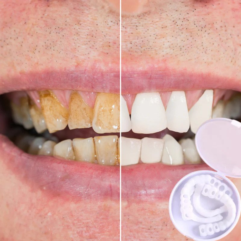 Snap-on Dents™ - Avec ces facettes, obtenez toujours le sourire parfait