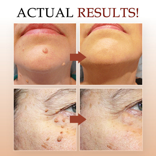 ClearRadiance™ — Faites disparaître les verrues rapidement et révélez une peau dont vous êtes fier(e) (1+1 GRATUIT AUJOURD'HUI !)