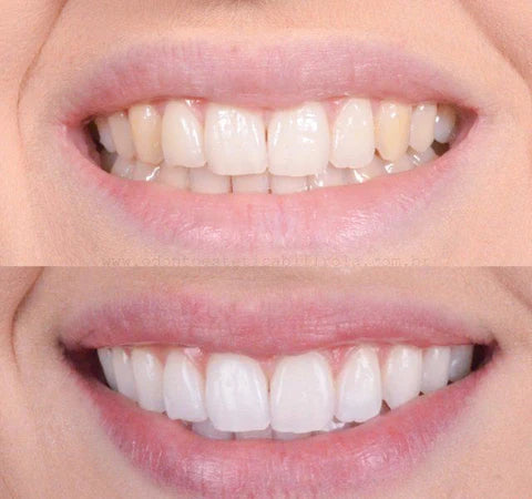 DazzlePro™ — Éveillez Instantanément l'Éclat Naturel et la Confiance de Votre Sourire