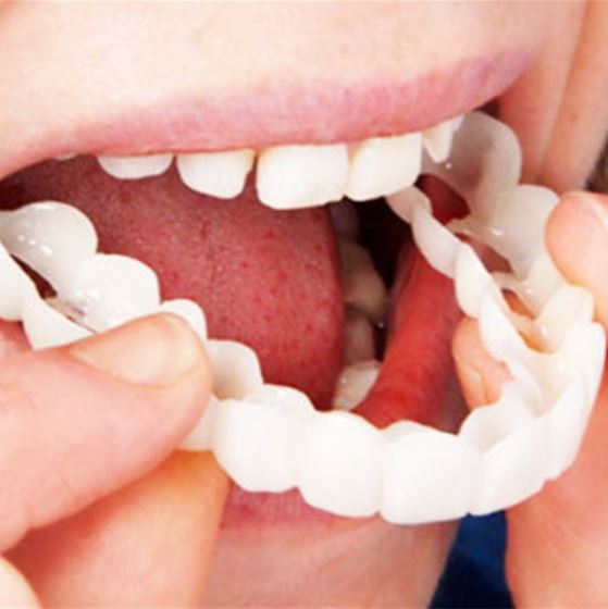 Snap-on Dents™ - Avec ces facettes, obtenez toujours le sourire parfait