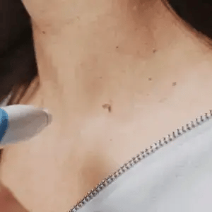 Set d'Élimination des Verrues et des Grands Grains de Beauté