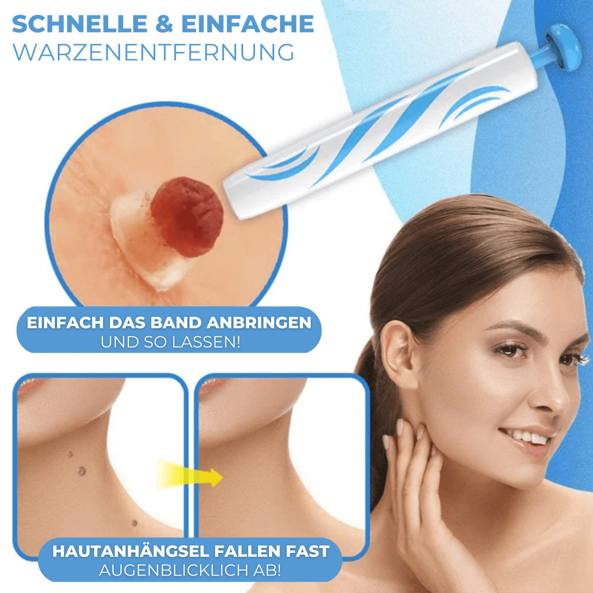 Set d'Élimination des Verrues et des Grands Grains de Beauté